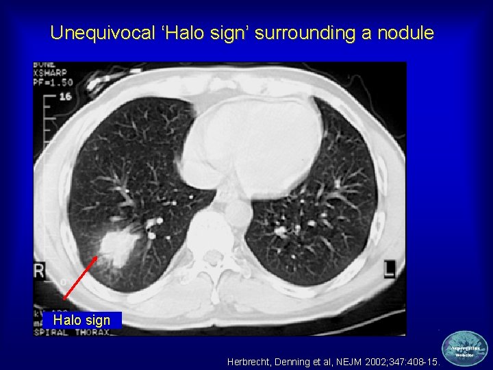 Unequivocal ‘Halo sign’ surrounding a nodule Halo sign Herbrecht, Denning et al, NEJM 2002;