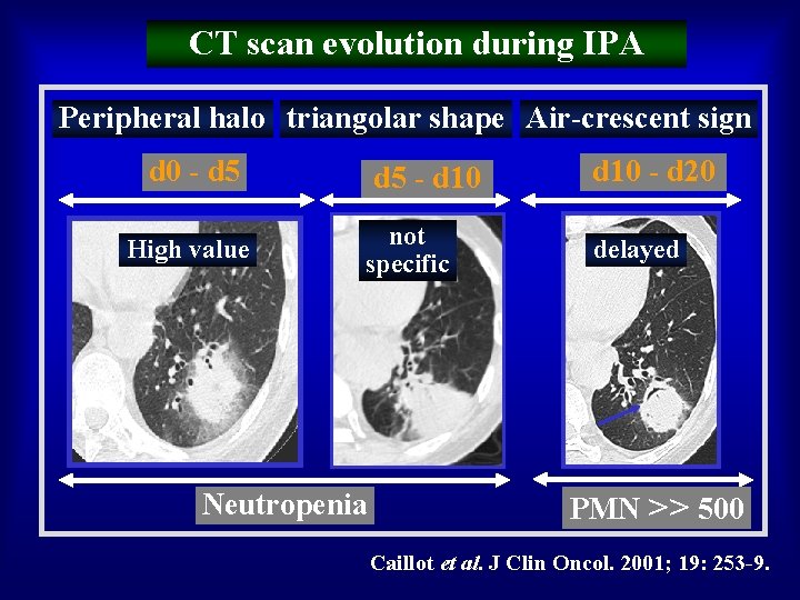 CT scan evolution during IPA Peripheral halo triangolar shape Air-crescent sign d 0 -