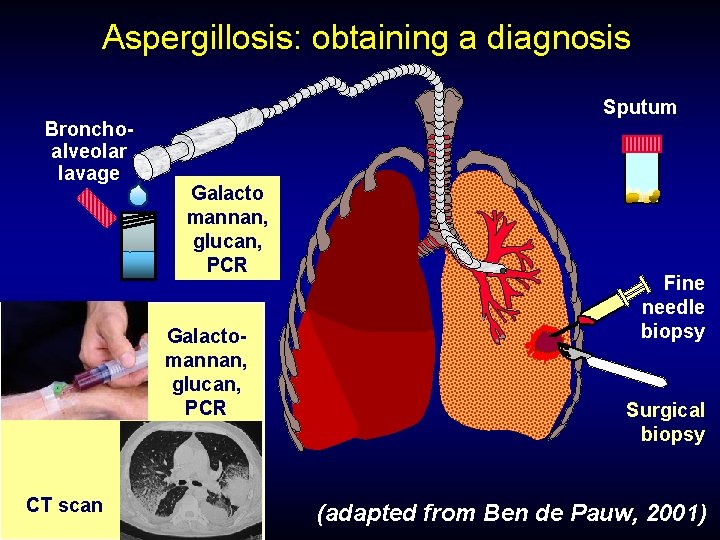 Aspergillosis: obtaining a diagnosis Sputum Bronchoalveolar lavage Galacto mannan, glucan, PCR Galactomannan, glucan, PCR