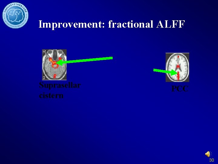Improvement: fractional ALFF Suprasellar cistern PCC 30 