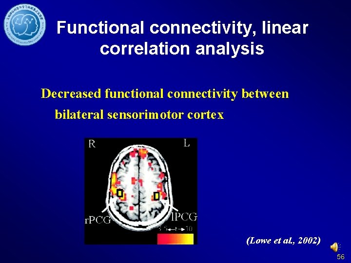 Functional connectivity, linear correlation analysis Decreased functional connectivity between bilateral sensorimotor cortex (Lowe et