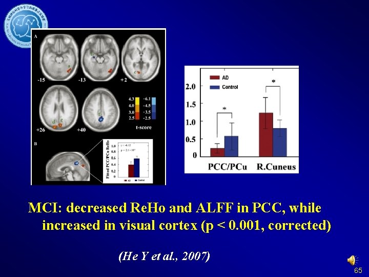 MCI: decreased Re. Ho and ALFF in PCC, while increased in visual cortex (p