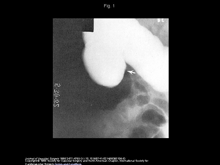 Fig. 1 Journal of Vascular Surgery 1985 2477 -479 DOI: (10. 1016/0741 -5214(85)90106 -5)