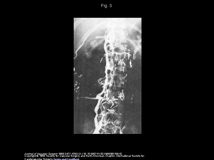 Fig. 3 Journal of Vascular Surgery 1985 2477 -479 DOI: (10. 1016/0741 -5214(85)90106 -5)