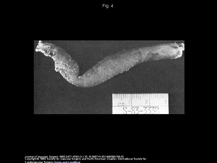 Fig. 4 Journal of Vascular Surgery 1985 2477 -479 DOI: (10. 1016/0741 -5214(85)90106 -5)