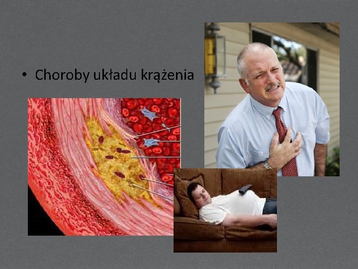  • Choroby układu krążenia 
