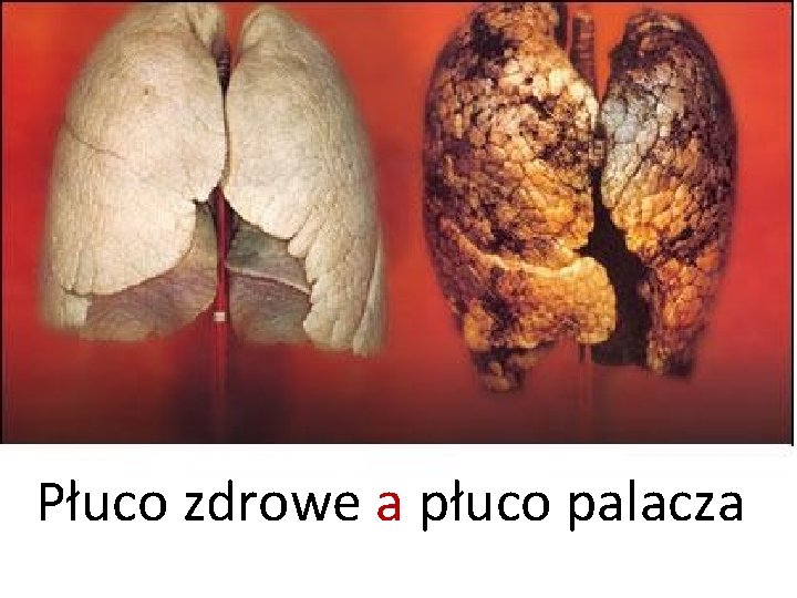 Płuco zdrowe a płuco palacza 