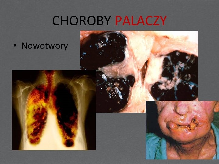 CHOROBY PALACZY • Nowotwory 