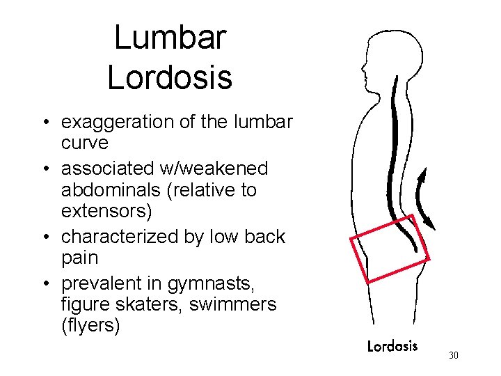 Lumbar Lordosis • exaggeration of the lumbar curve • associated w/weakened abdominals (relative to