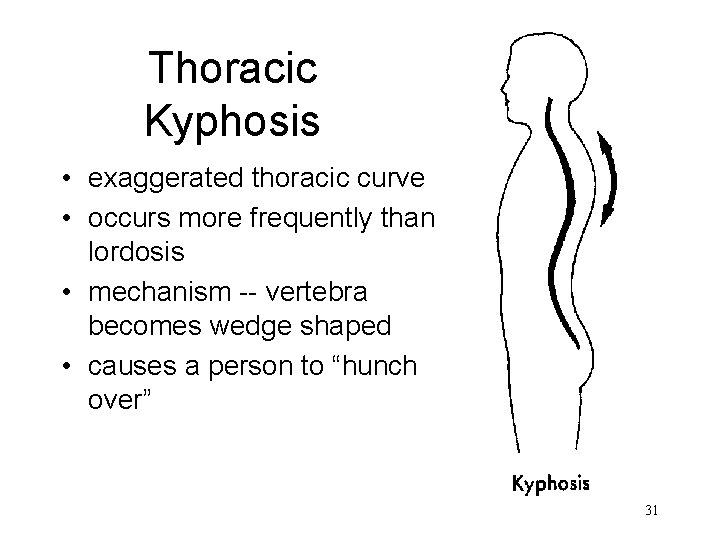 Thoracic Kyphosis • exaggerated thoracic curve • occurs more frequently than lordosis • mechanism