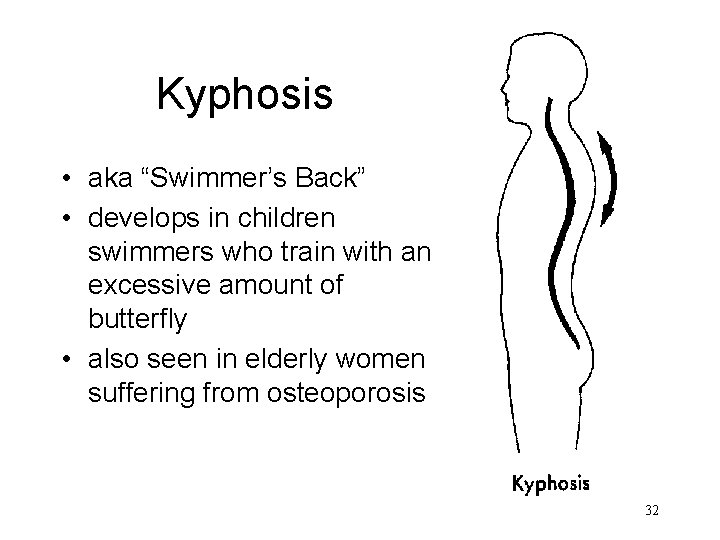 Kyphosis • aka “Swimmer’s Back” • develops in children swimmers who train with an