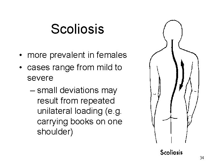 Scoliosis • more prevalent in females • cases range from mild to severe –