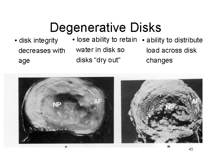 Degenerative Disks • lose ability to retain • ability to distribute • disk integrity Degenerative Disks • lose ability to retain • ability to distribute • disk integrity