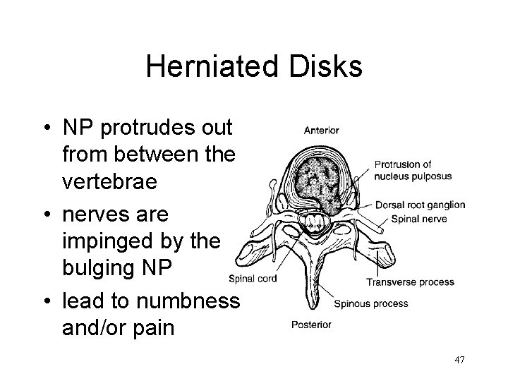 Herniated Disks • NP protrudes out from between the vertebrae • nerves are impinged Herniated Disks • NP protrudes out from between the vertebrae • nerves are impinged