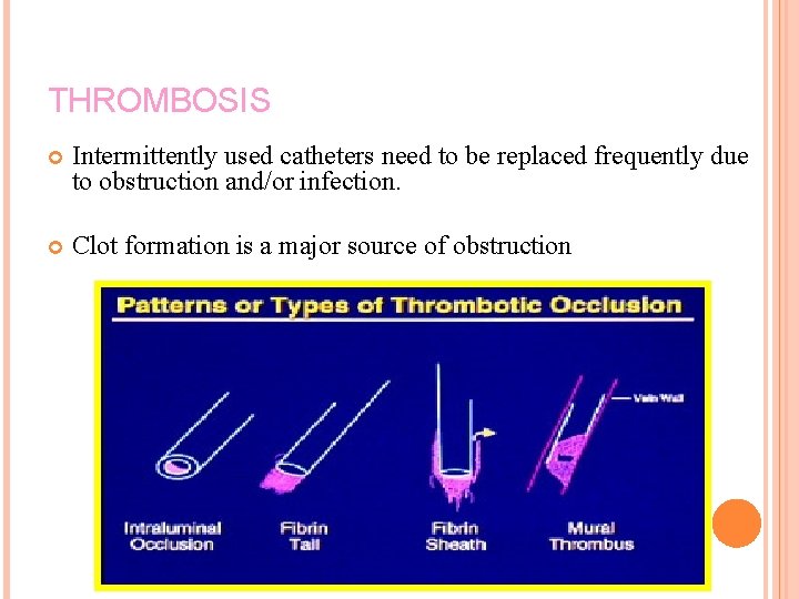 THROMBOSIS Intermittently used catheters need to be replaced frequently due to obstruction and/or infection.