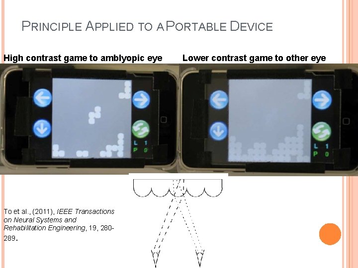 PRINCIPLE APPLIED TO A PORTABLE DEVICE High contrast game to amblyopic eye To et