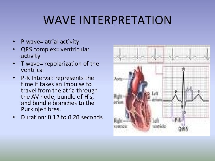 WAVE INTERPRETATION • P wave= atrial activity • QRS complex= ventricular activity • T