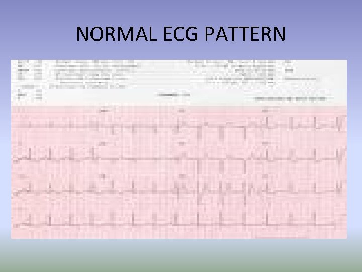 NORMAL ECG PATTERN 