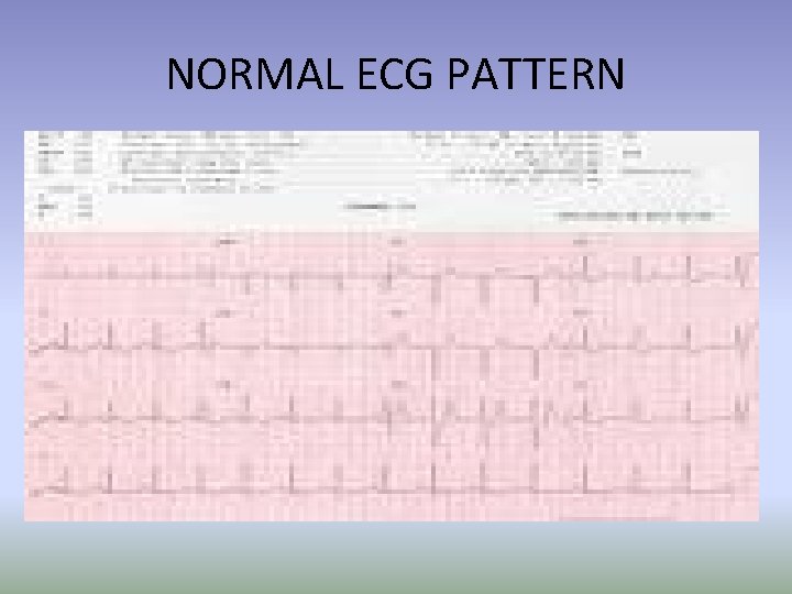 NORMAL ECG PATTERN NORMAL ECG PATTERN