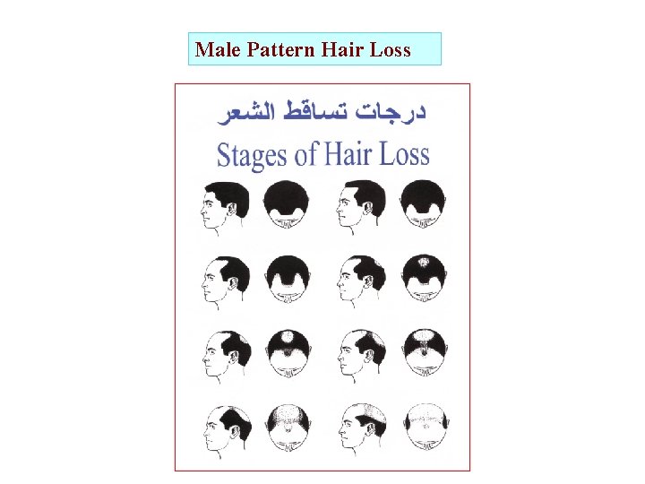 Male Pattern Hair Loss 