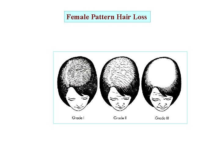 Female Pattern Hair Loss 