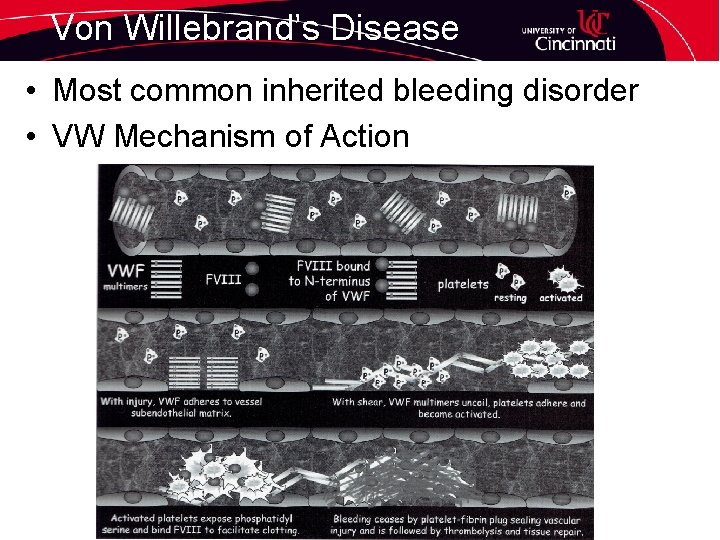 Von Willebrand’s Disease • Most common inherited bleeding disorder • VW Mechanism of Action