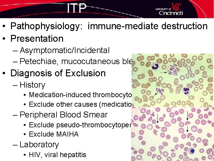 ITP • Pathophysiology: immune-mediate destruction • Presentation – Asymptomatic/Incidental – Petechiae, mucocutaneous bleed •