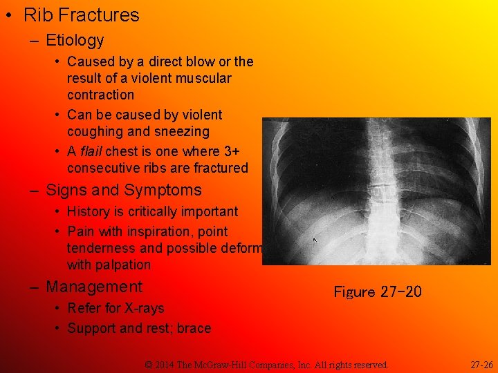  • Rib Fractures – Etiology • Caused by a direct blow or the