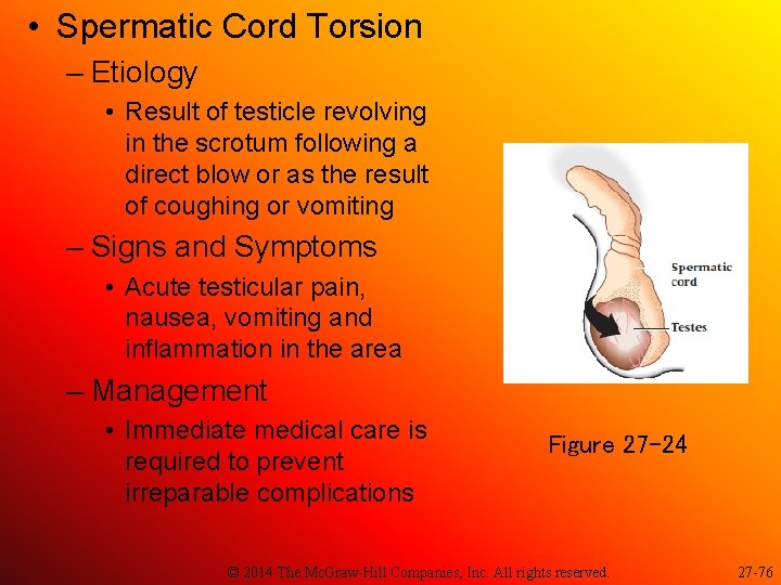  • Spermatic Cord Torsion – Etiology • Result of testicle revolving in the