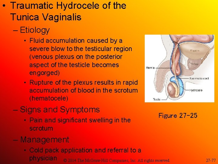  • Traumatic Hydrocele of the Tunica Vaginalis – Etiology • Fluid accumulation caused