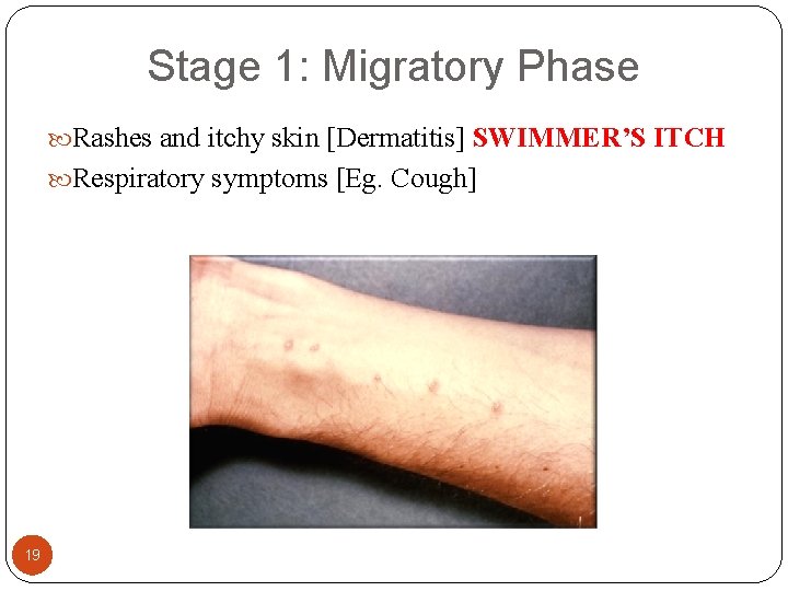 Stage 1: Migratory Phase Rashes and itchy skin [Dermatitis] SWIMMER’S ITCH Respiratory symptoms [Eg.