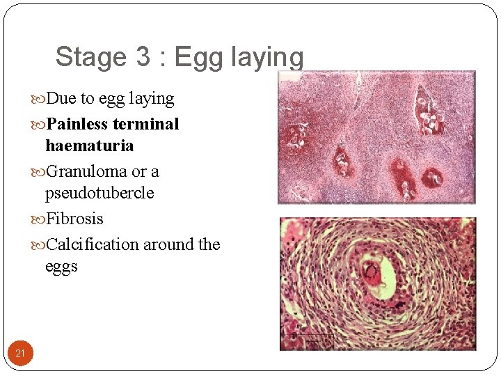 Stage 3 : Egg laying Due to egg laying Painless terminal haematuria Granuloma or