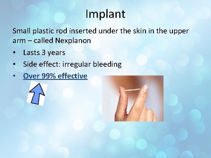 Implant Small plastic rod inserted under the skin in the upper arm – called