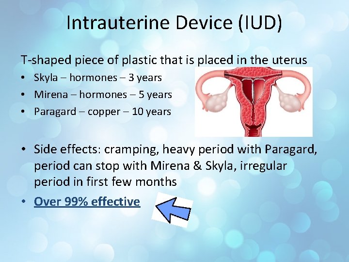 Intrauterine Device (IUD) T-shaped piece of plastic that is placed in the uterus •