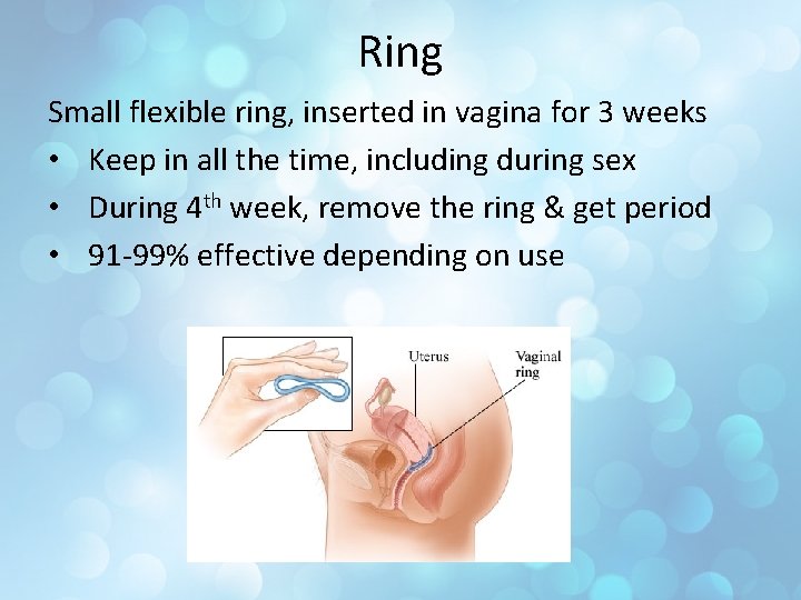 Ring Small flexible ring, inserted in vagina for 3 weeks • Keep in all