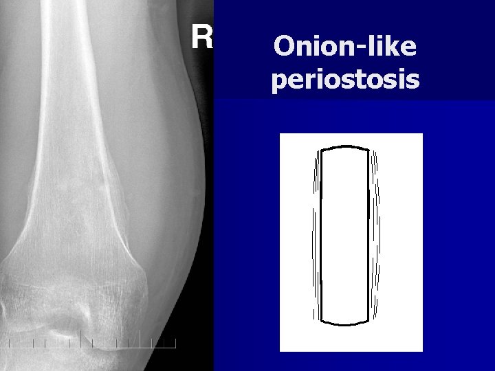 Onion-like periostosis 