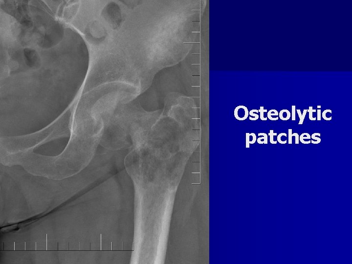 Osteolytic patches 