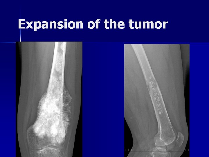 Expansion of the tumor 