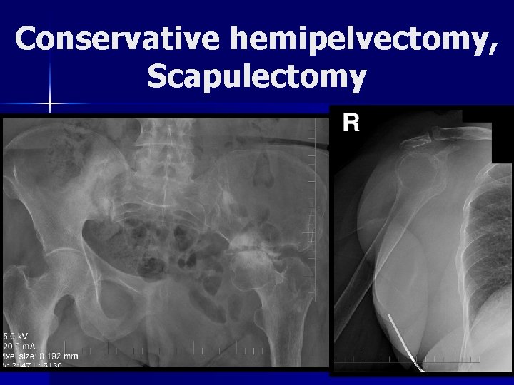 Conservative hemipelvectomy, Scapulectomy 