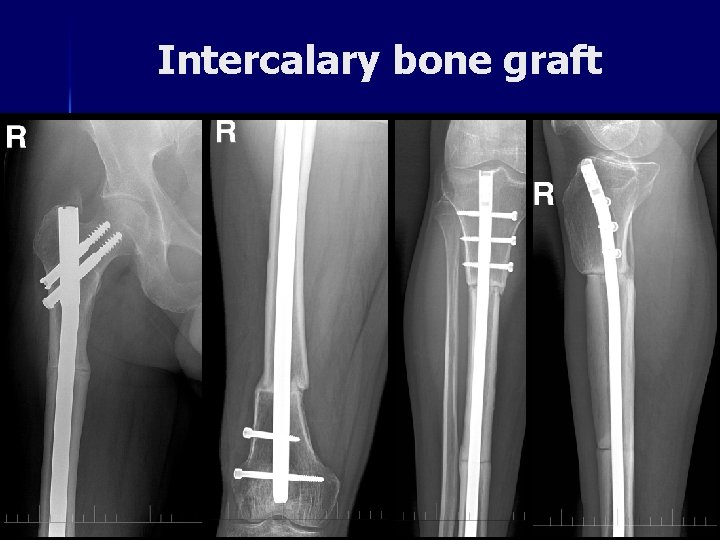 Intercalary bone graft 