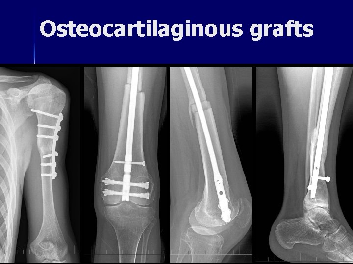 Osteocartilaginous grafts 