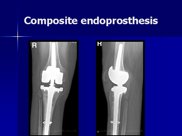 Composite endoprosthesis 