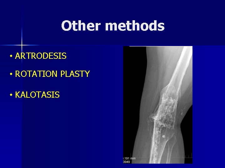 Other methods • ARTRODESIS • ROTATION PLASTY • KALOTASIS 