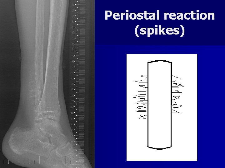 Periostal reaction (spikes) 