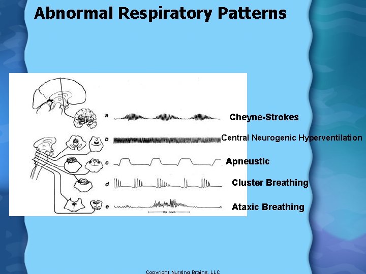 Abnormal Respiratory Patterns Cheyne-Strokes Central Neurogenic Hyperventilation Apneustic Cluster Breathing Ataxic Breathing 