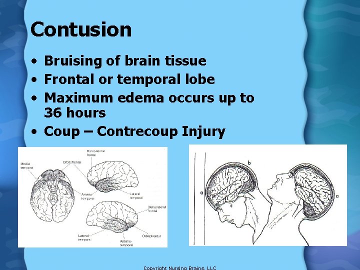 Contusion • Bruising of brain tissue • Frontal or temporal lobe • Maximum edema