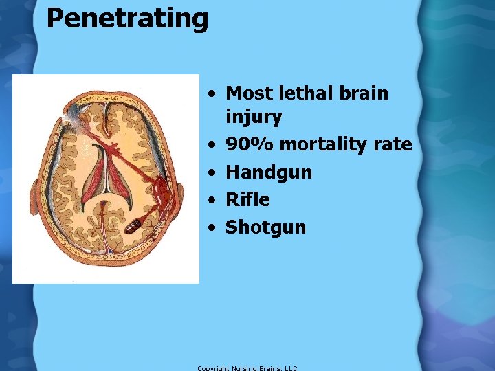 Penetrating • Most lethal brain injury • 90% mortality rate • Handgun • Rifle