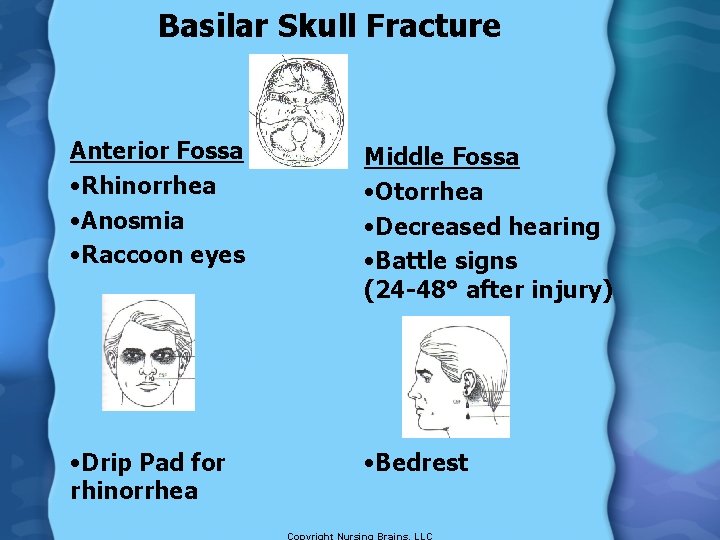 Basilar Skull Fracture Anterior Fossa • Rhinorrhea • Anosmia • Raccoon eyes Middle Fossa