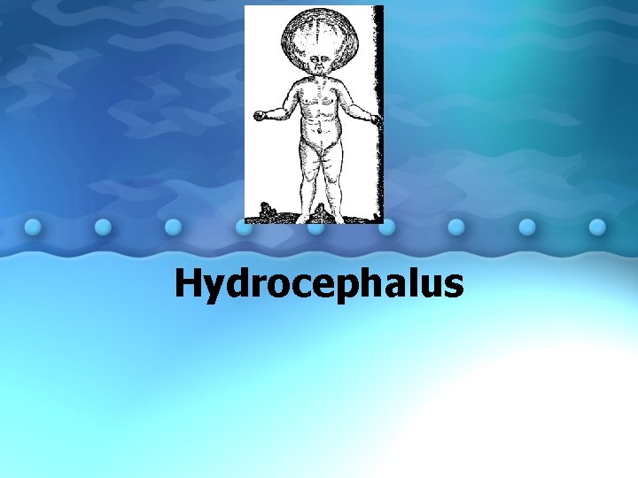 Hydrocephalus 