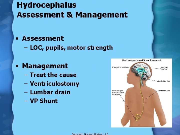 Hydrocephalus Assessment & Management • Assessment – LOC, pupils, motor strength • Management –